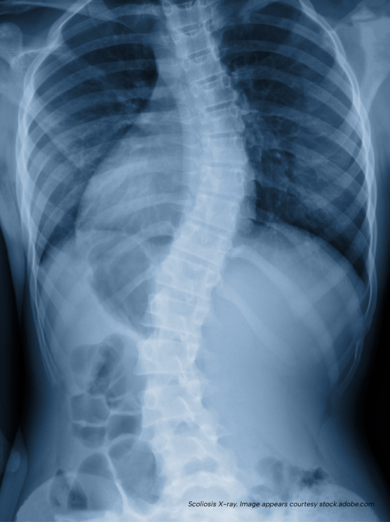 X-ray image showing a pronounced S-shaped scoliosis curve through the thoracic and lumbar spine, demonstrating how spinal curvature can affect the shape of the chest cavity.