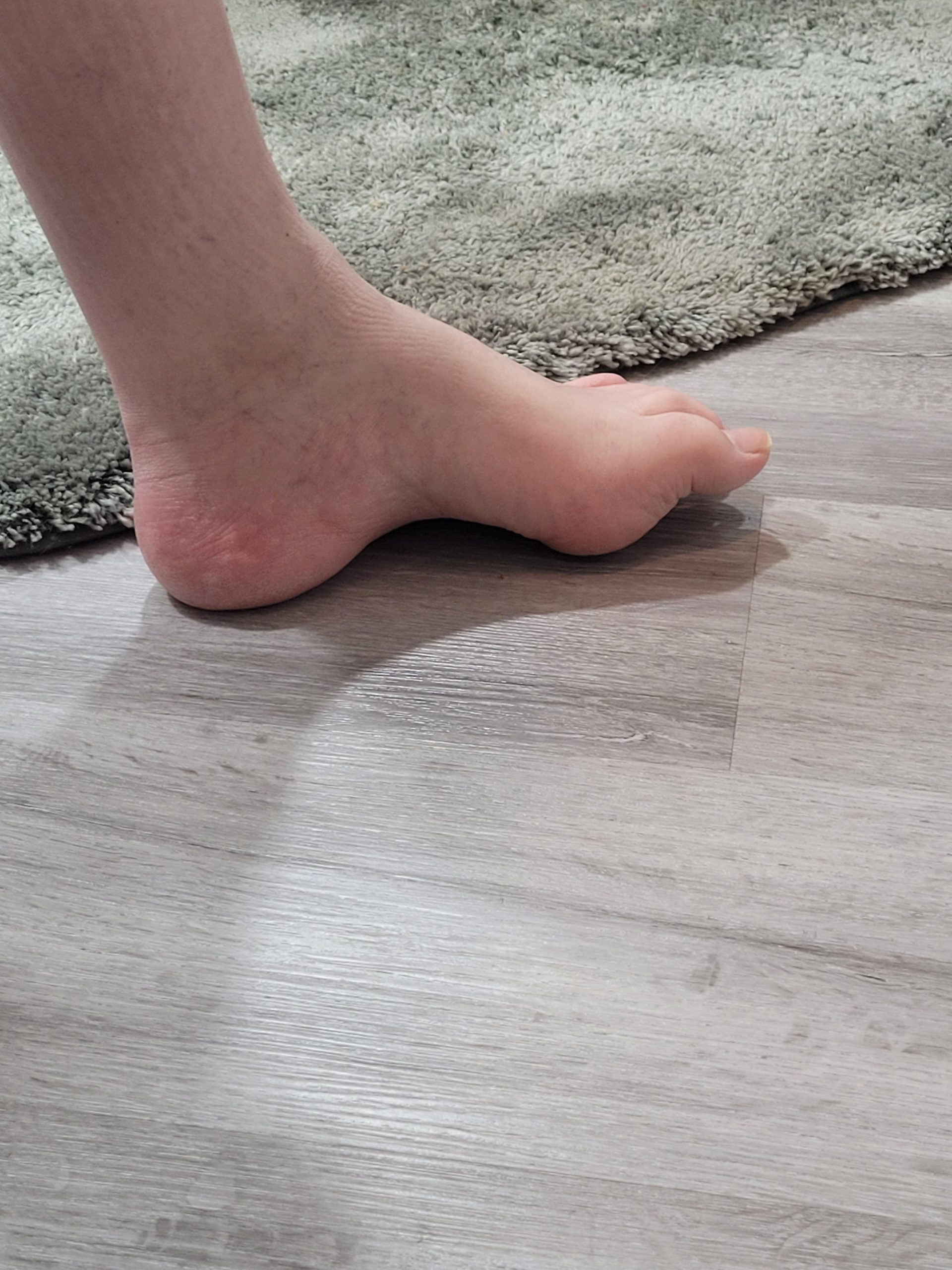 Weight-bearing left foot with the cavovarus deformity caused by Charcot-Marie-Tooth disease (CMT), showing the elevated arch lifted off the floor while the heel and forefoot bear the load.