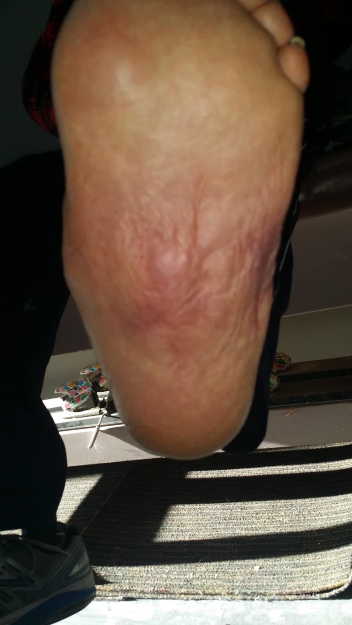 Sole of a foot in the acute phase of Charcot neuroarthropathy, showing swelling and red, dusky discoloration across the midfoot with no open wound.