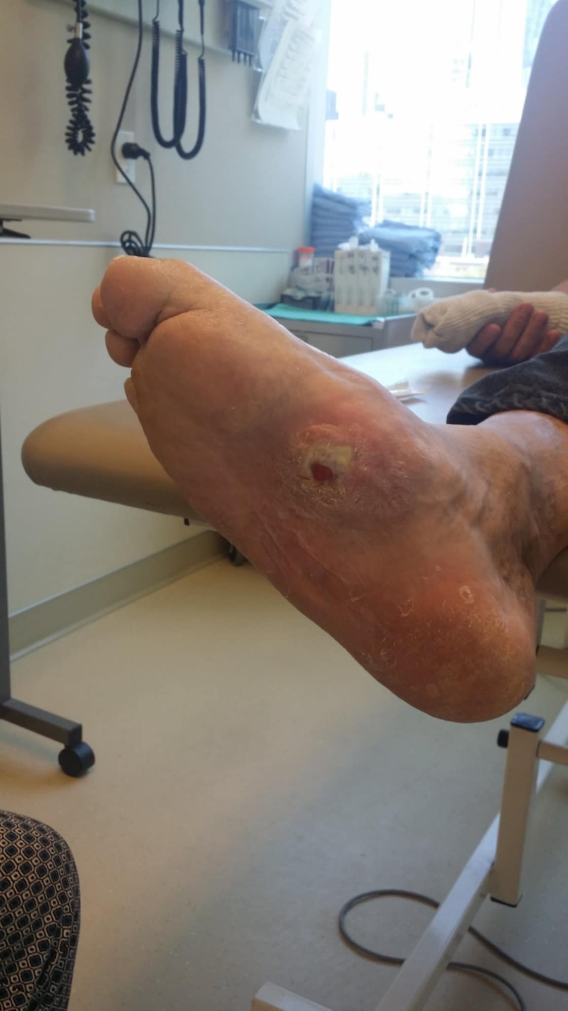 Side profile of a foot with Charcot neuroarthropathy, showing the collapsed midfoot and downward-bowing rocker-bottom contour with a pressure ulcer at the plantar prominence.