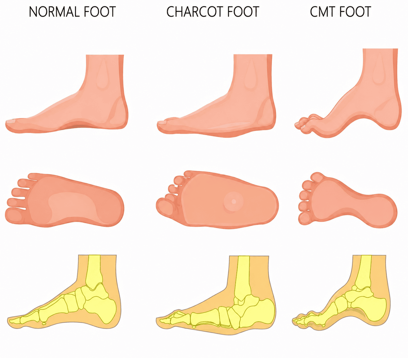 Illustration comparing the normal foot, the Charcot foot, and the CMT foot in three views each: side profile, sole, and skeletal side view. The Charcot foot shows a collapsed arch, widened sole, and displaced midfoot bones. The CMT foot shows a high arch, clawed toes, and a narrow midfoot.