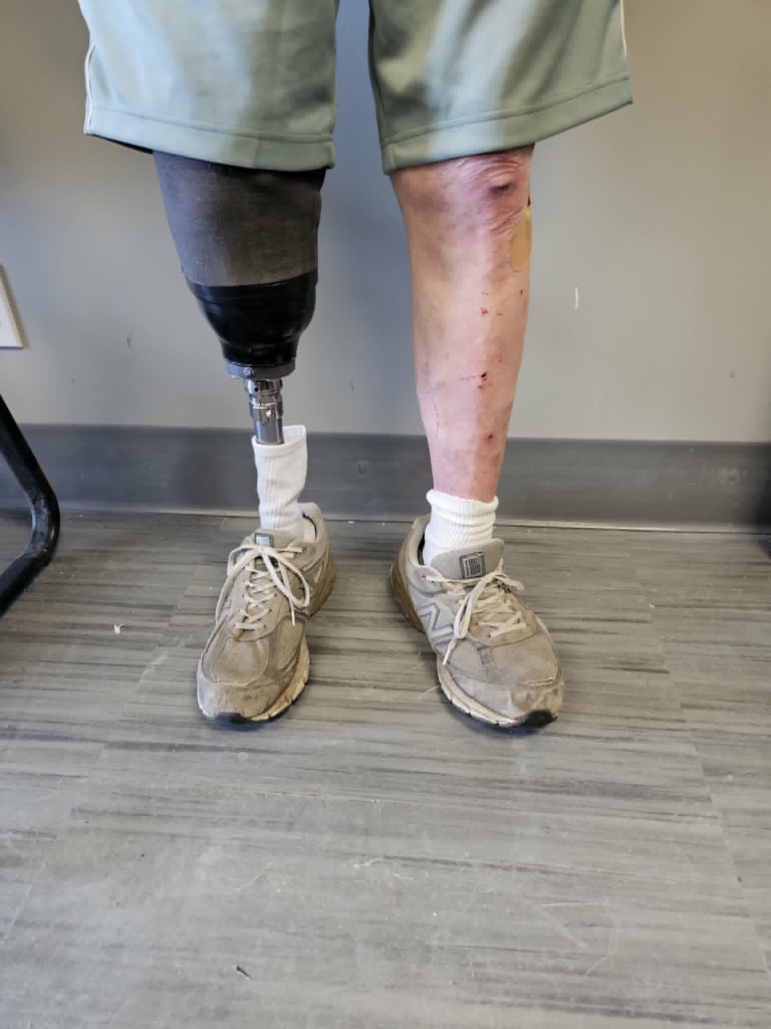 Person standing with a transtibial (below-the-knee) prosthesis on the left leg beside their intact right leg, following amputation resulting from Charcot neuroarthropathy.